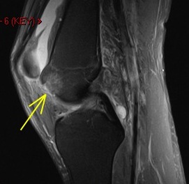 Figure 4 for case Osteochondral fracture femur with displaced fragment